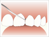 歯石3